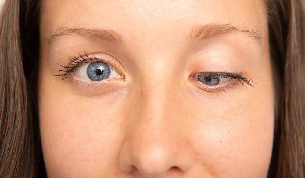 Oculoplastica 2 ptoza palpebrala