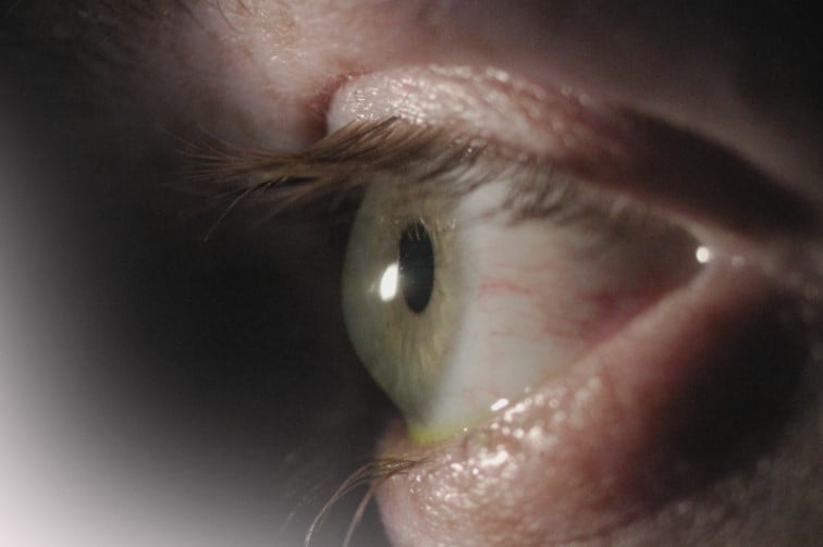 Cornee și Sindromul de Ochi Uscat 3 keratoconus