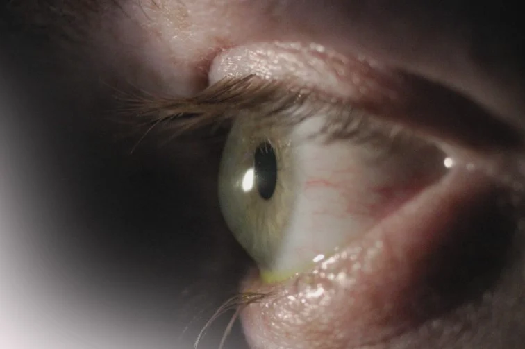 keratoconus