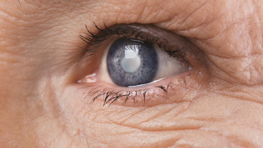 cataracta