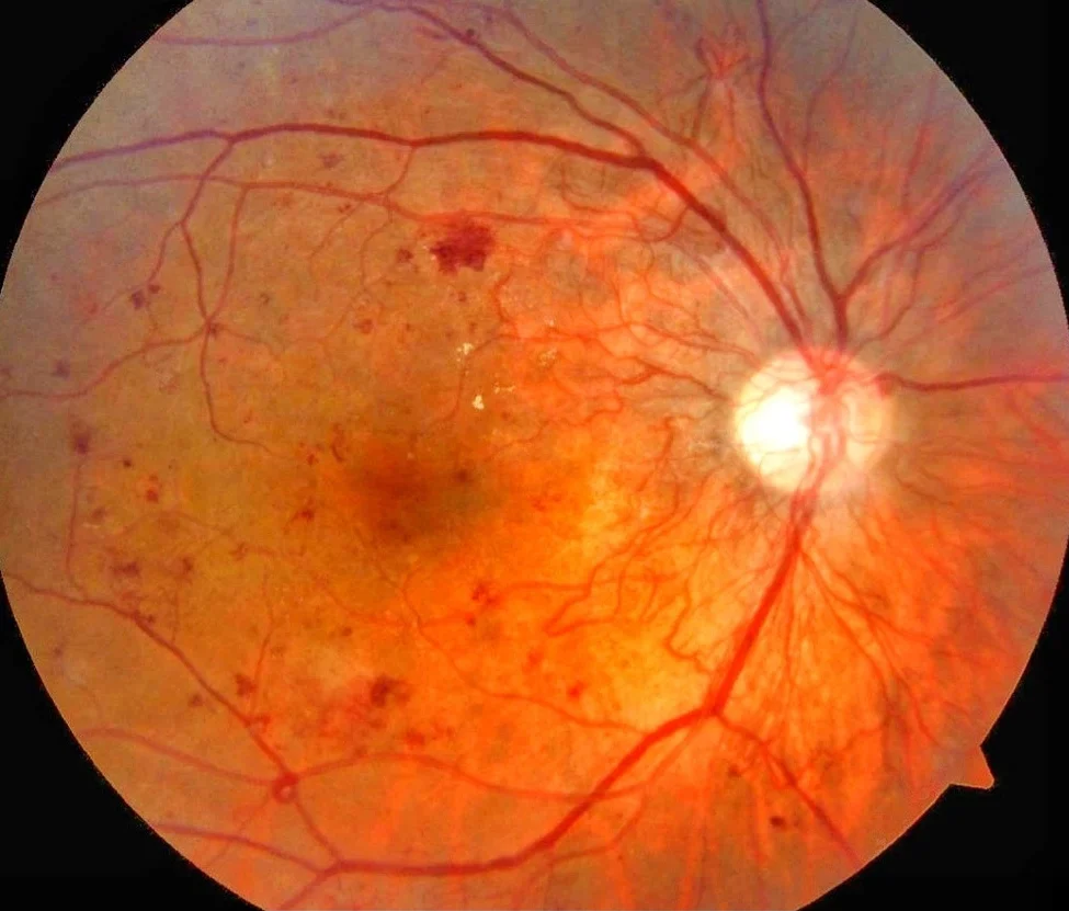 retinopatie diabetica