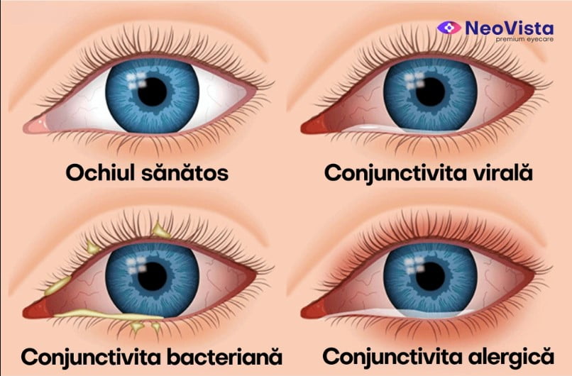 tipurile de conjunctivita