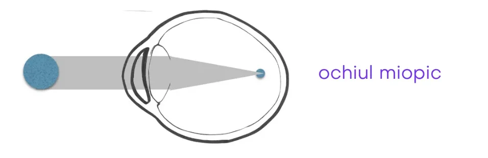 ochiul_miopic